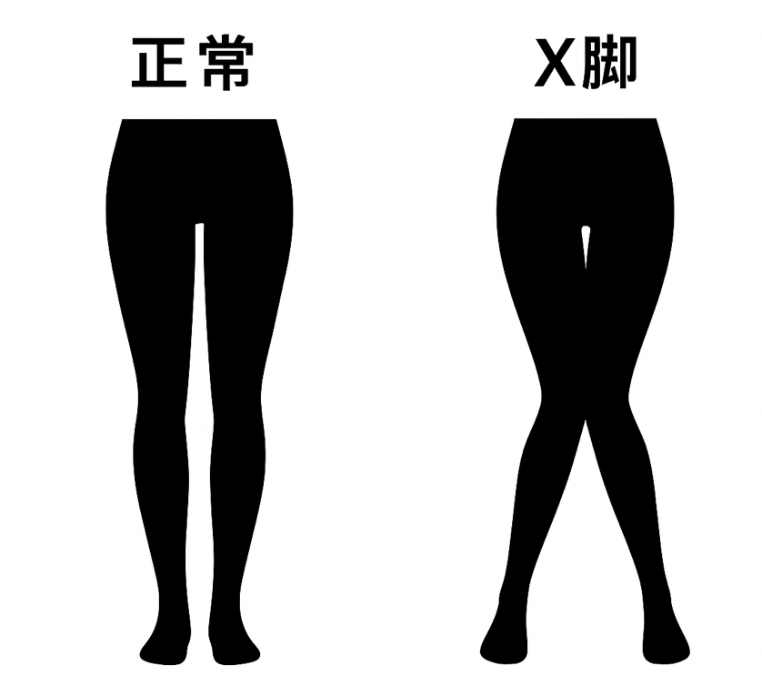 X脚とは?〜原因と対策〜