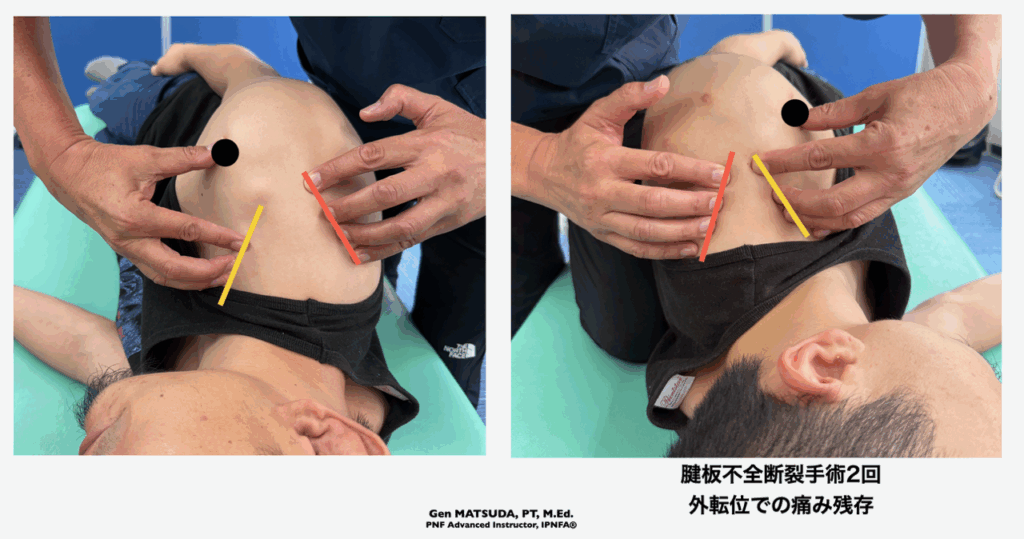 肩関節腱板損傷術後のリハビリ
