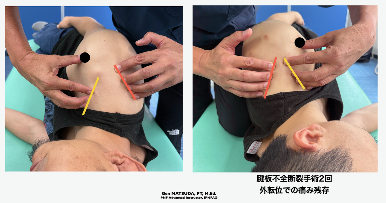 肩関節腱板損傷術後のリハビリ | PNFリハビリセンター